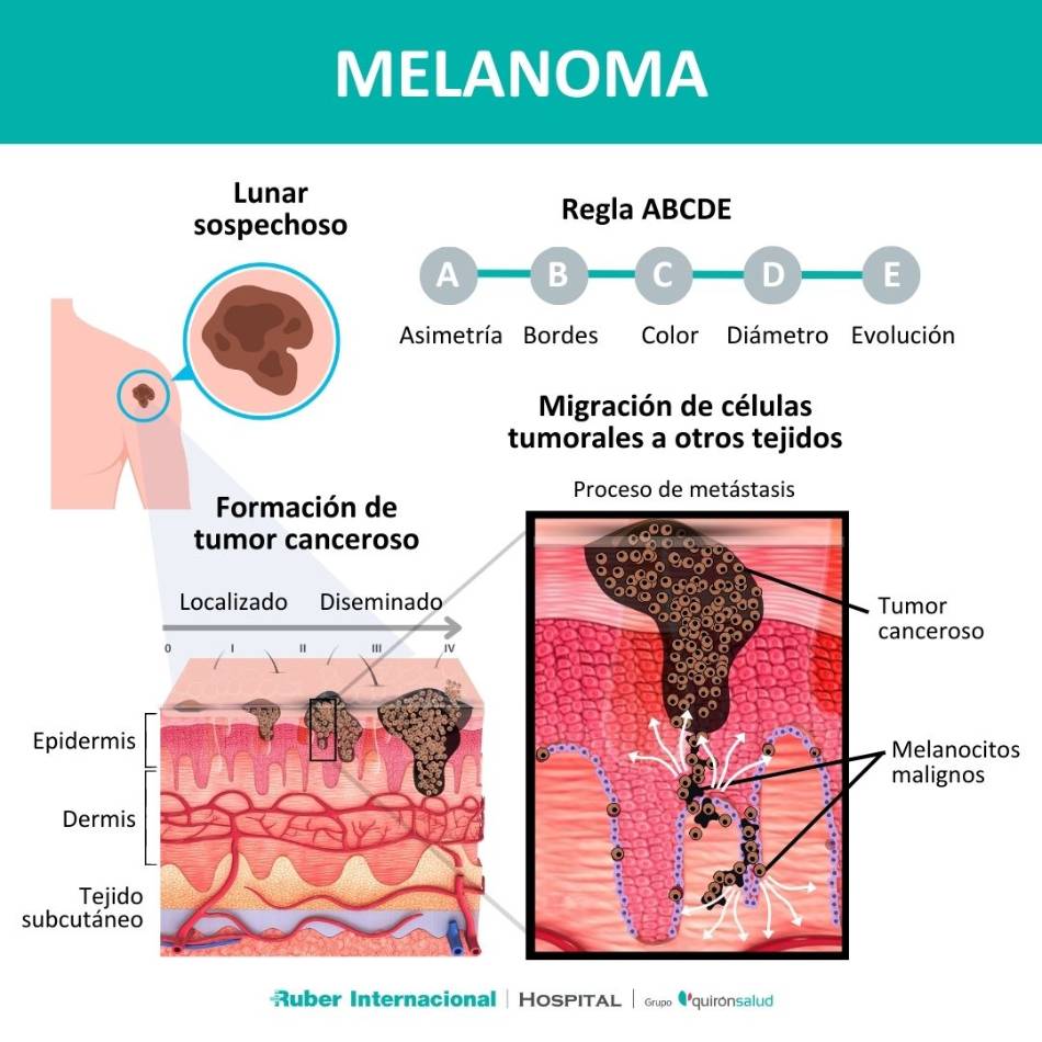 Día Mundial Contra El Melanoma